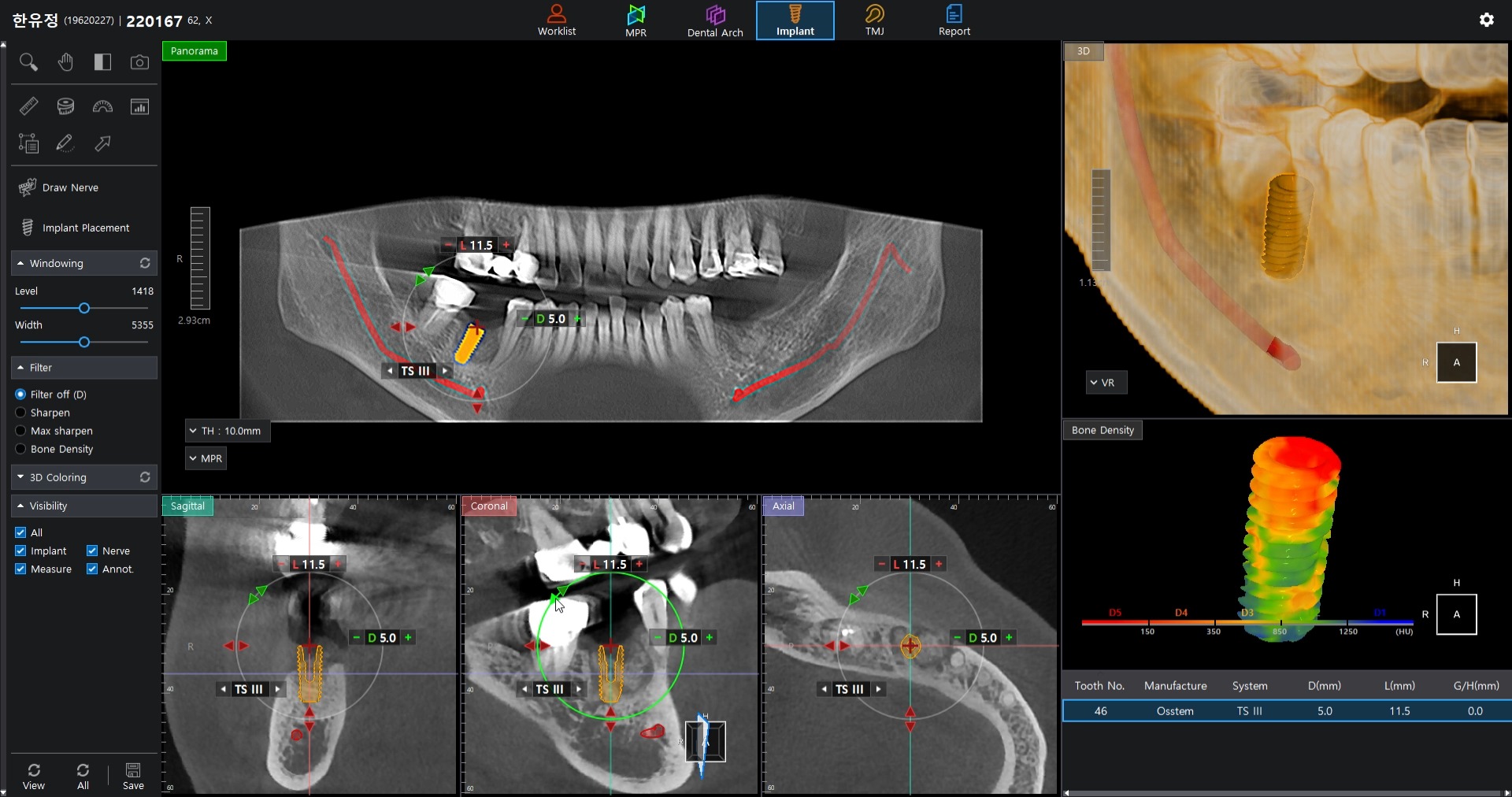 ⭕️One3 CBCT Viewer 1.3: The Smart Choice for Implant Consultation ...