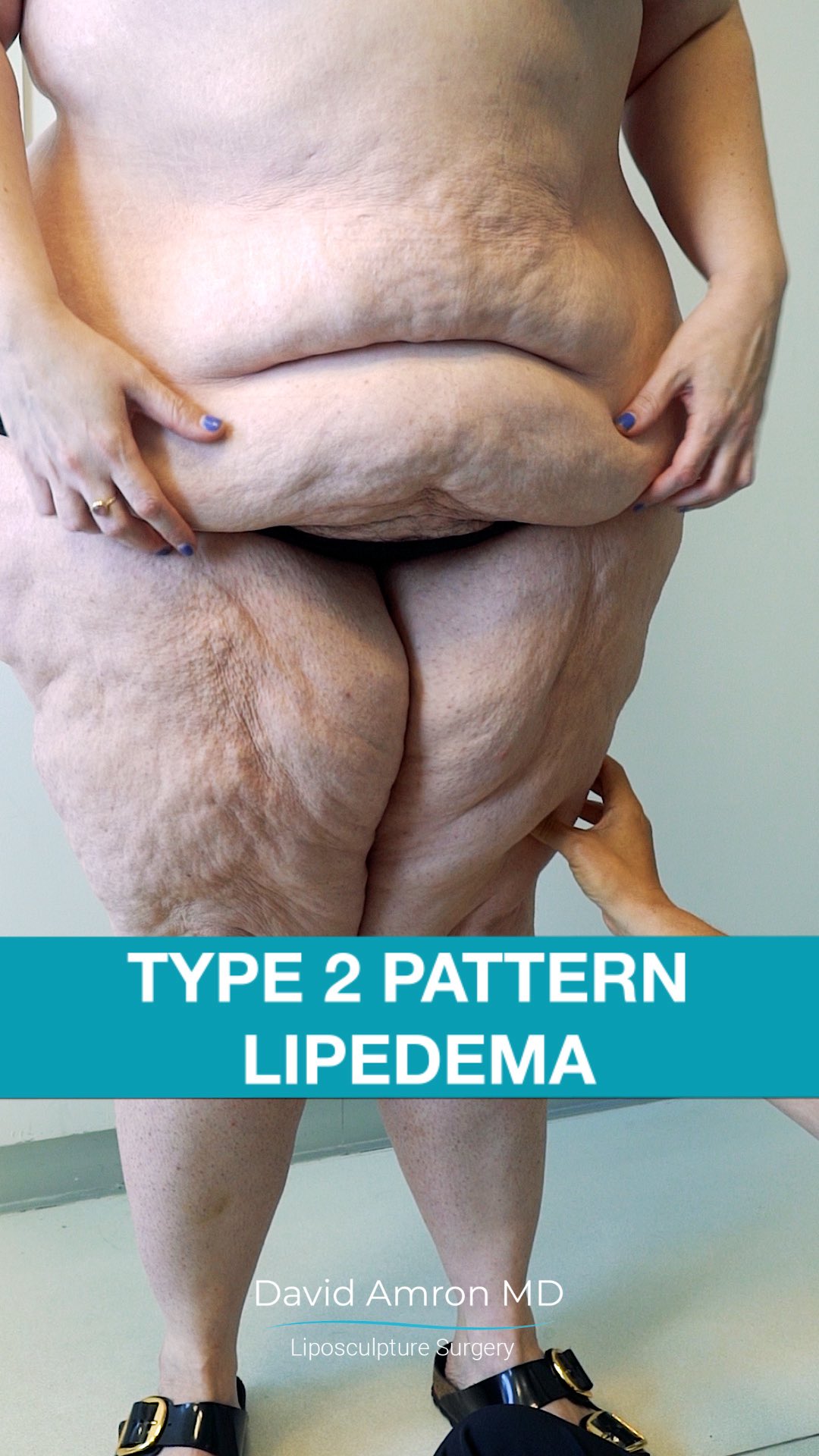 What happens when you stop taking Zepbound (Tirzepatide) for lipedema? Many patients don't realize how much it helps until they go off it—especially before su | Atlantic Surgical Associates