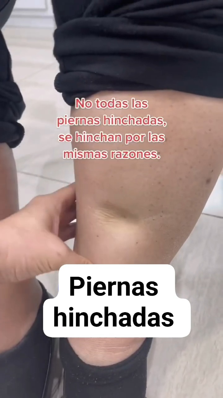 Las piernas no solo se hinchan por diabetes, también pueden hincharse ...