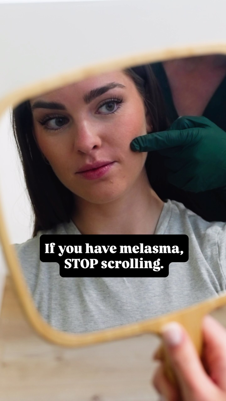Melasma can be one of the most frustrating skin concerns, but you do not have to navigate it alone. 💚, Unlike a typical sun spot, melasma often requires a personalized treatment plan and ongoing care 