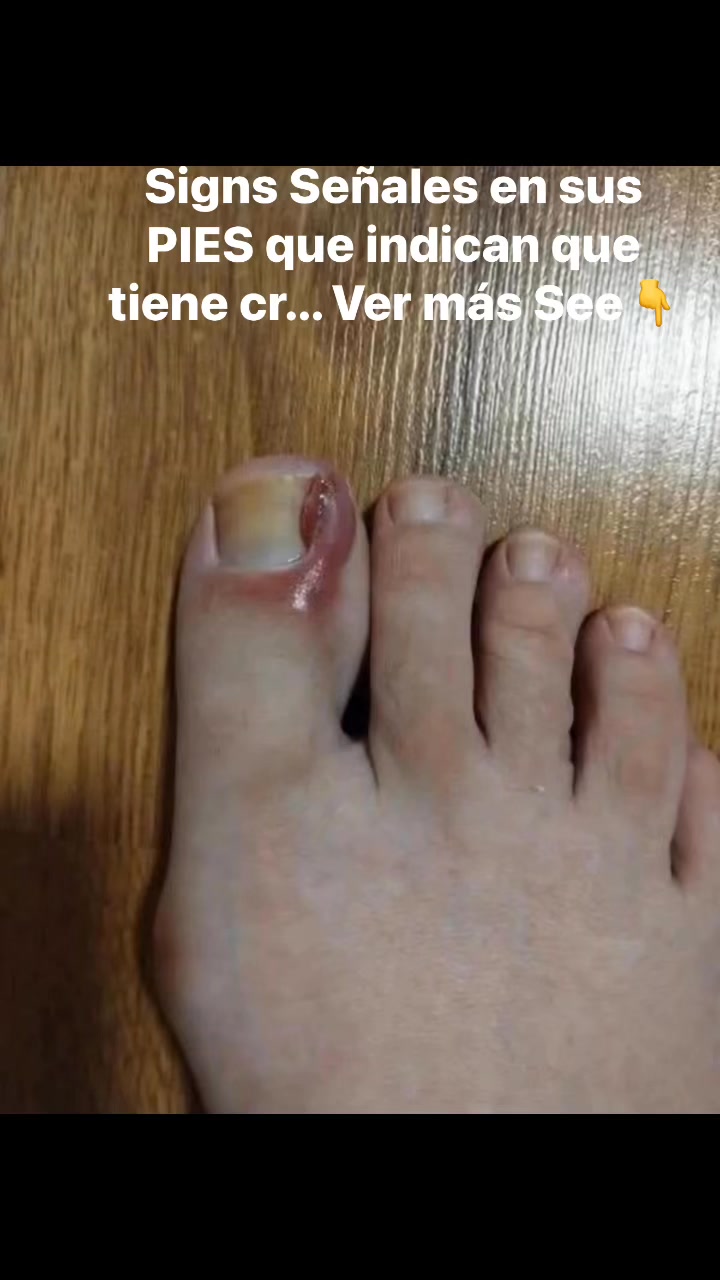 Signs Señales en sus PIES que indican que tiene cr... Ver más See👇 ...