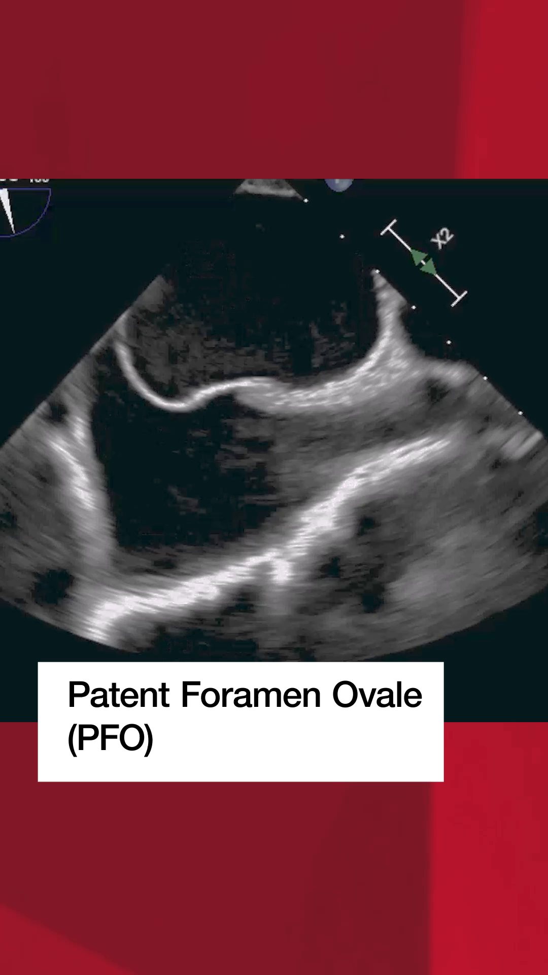 A patent foramen ovale (PFO) is an opening between the right and left ...