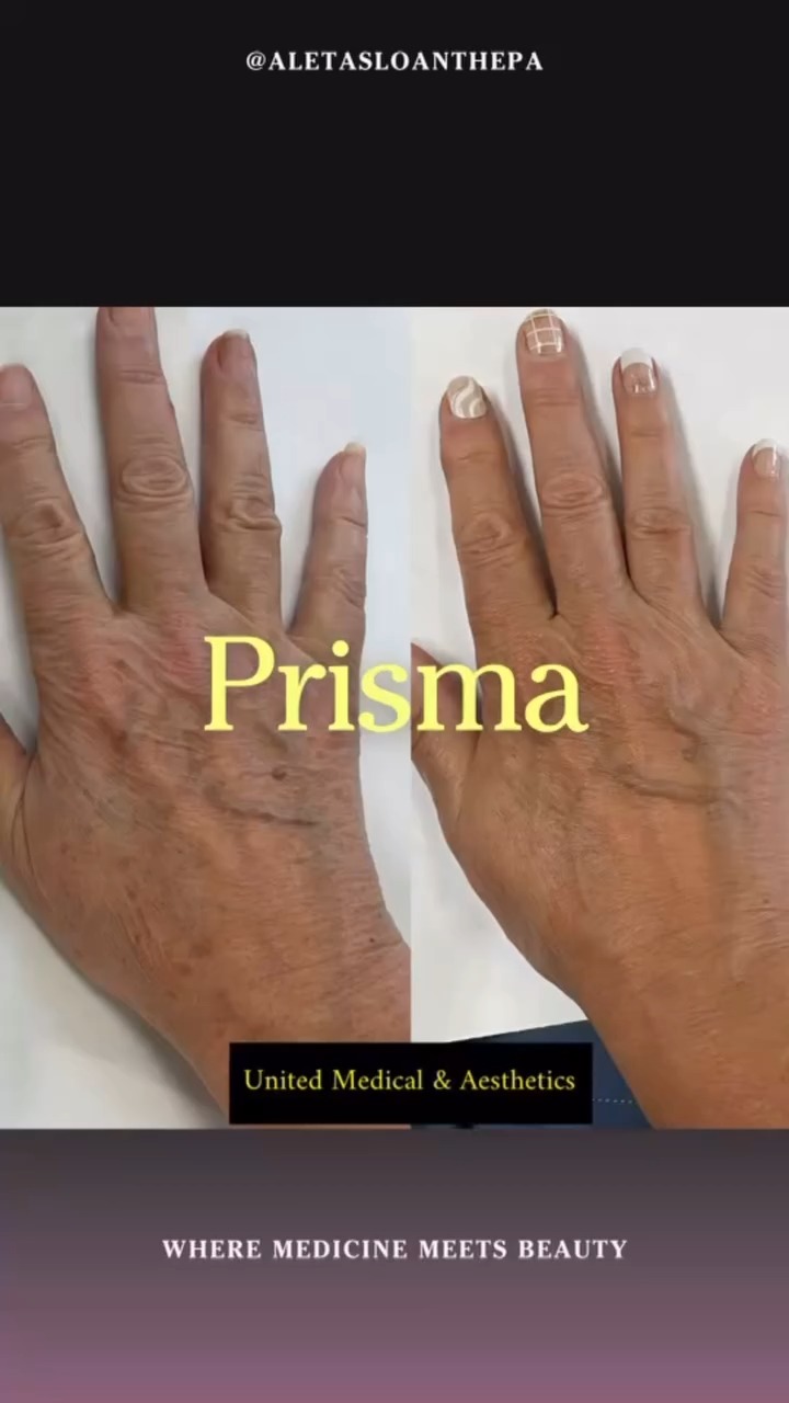 Aging hands? Prisma IPL has it HANDled. 🙌 This stunning transformation ...