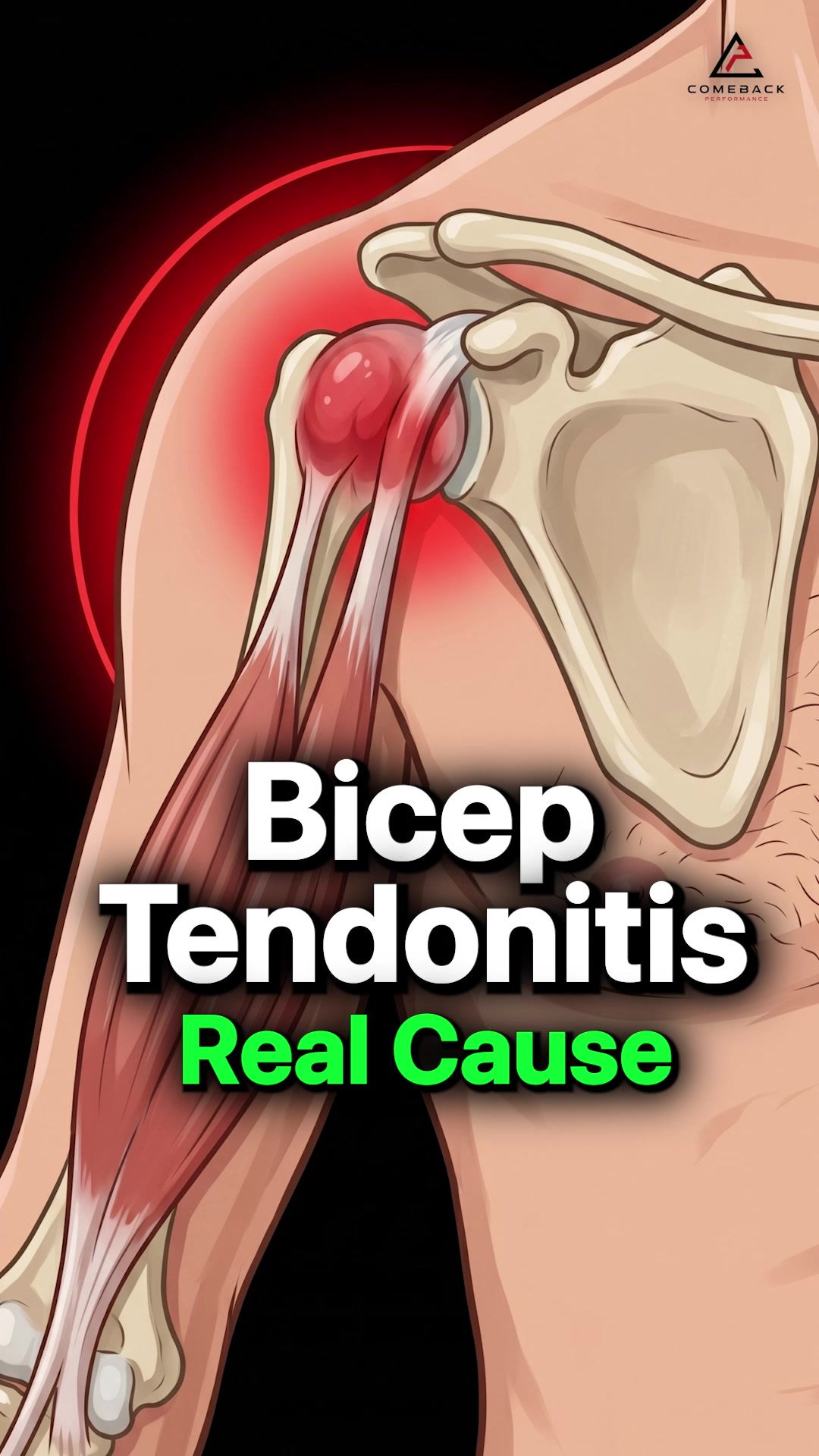 bpc 157 bicep tendonitis @lcmfitness_nj you heard it here first 🤣, part 2 with @zackmindel 🔥 Biceps Tendonitis: Why Your