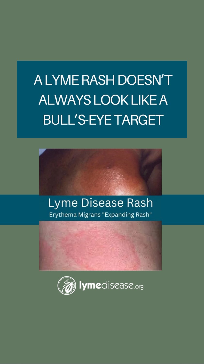We often hear the terms “erythema migrans” and “bull’s-eye rash” 🎯 used ...