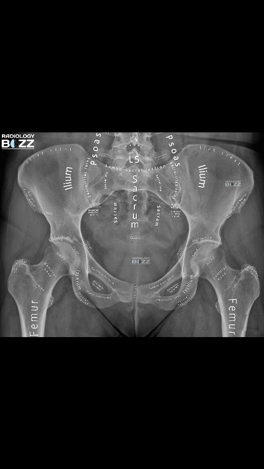 🩻 AP Pelvis X-ray | Radiographic Anatomy Explained 🦴 A beautifully ...