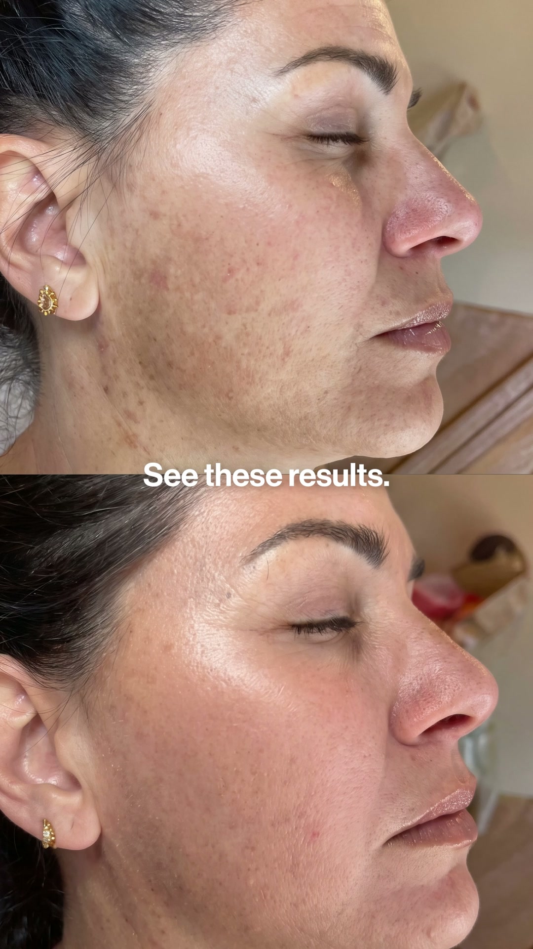 glutathione reduce pigmentation Meet your glow upgrade ✨, A powerful blend of Glutathione, Niacinamide & Melazero™ works deep within the skin to pigmentation, brighten tone & restore barrier health., Because clear, even skin ghk-cu copper peptide hair