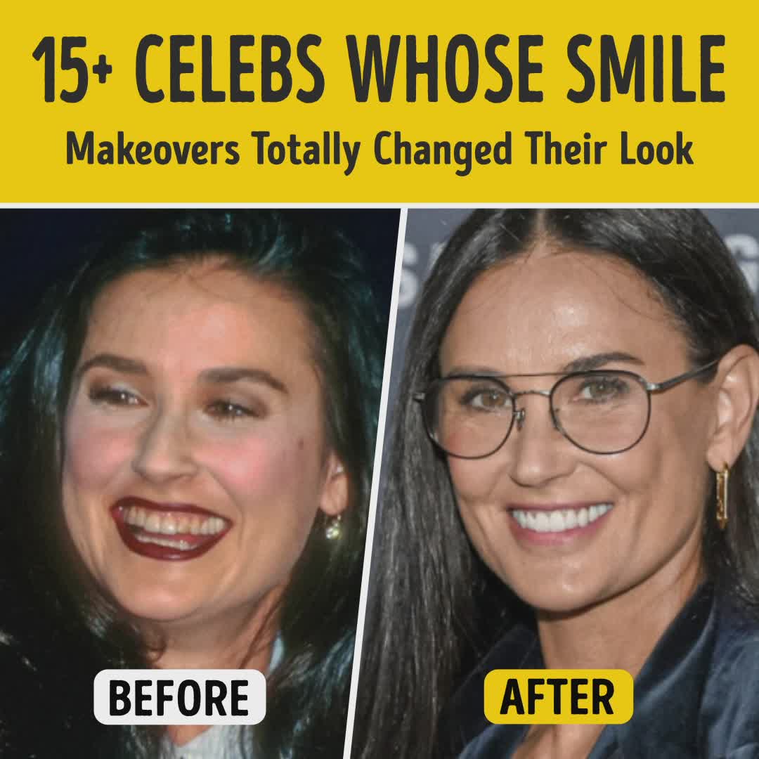 15+ Celebs Whose Smile Makeovers Totally Changed Their Look | Smart is ...