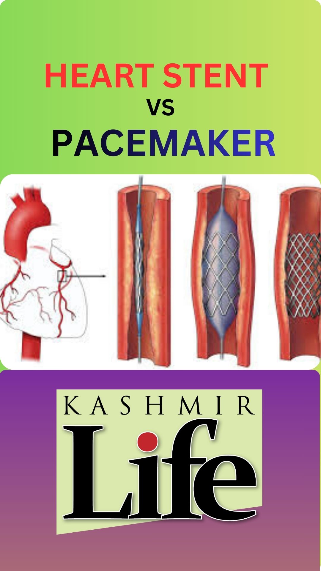𝐖𝐡𝐚𝐭 𝐢𝐬 #𝐏𝐚𝐜𝐞𝐦𝐚𝐤𝐞𝐫, #𝐒𝐭𝐞𝐧𝐭 𝐚𝐧𝐝 𝐎𝐩𝐞𝐧 𝐇𝐞𝐚𝐫𝐭 #𝐒𝐮𝐫𝐠𝐞𝐫𝐲 𝐰𝐚𝐭𝐜𝐡 𝐟𝐮𝐥𝐥 𝐞𝐩𝐢𝐬𝐨𝐝𝐞 ...