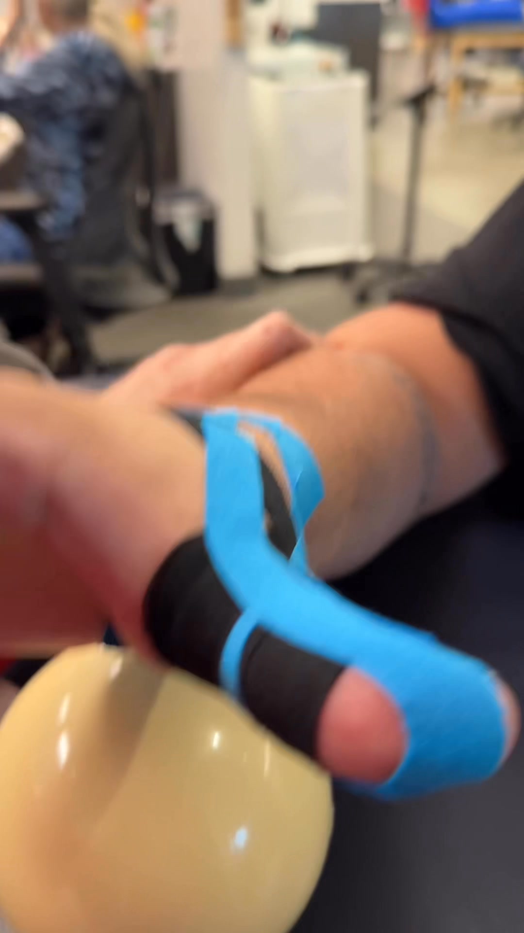 Chronic RCL injury of the thumb. So….It helps if you actually hit ...