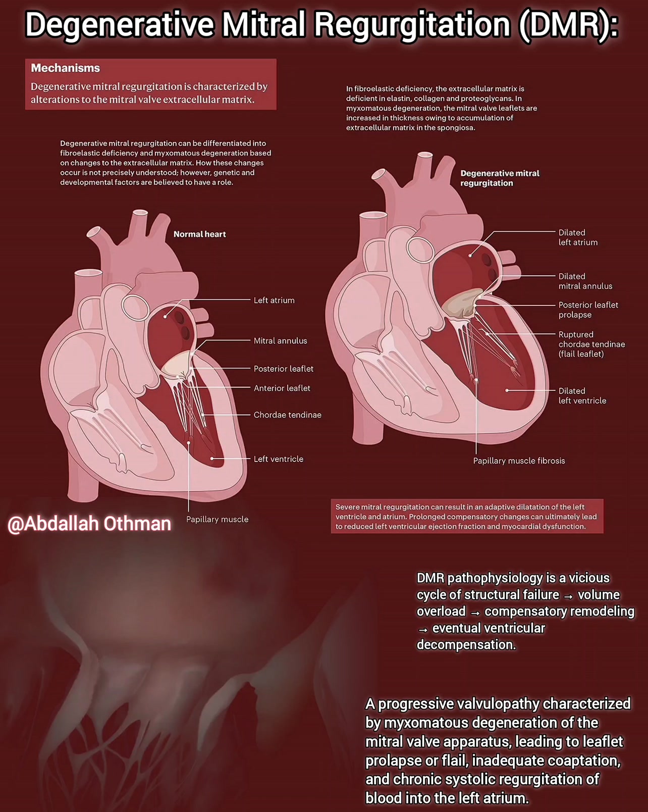 Degenerative Mitral Regurgitation (DMR) Progressive valvulopathy from ...