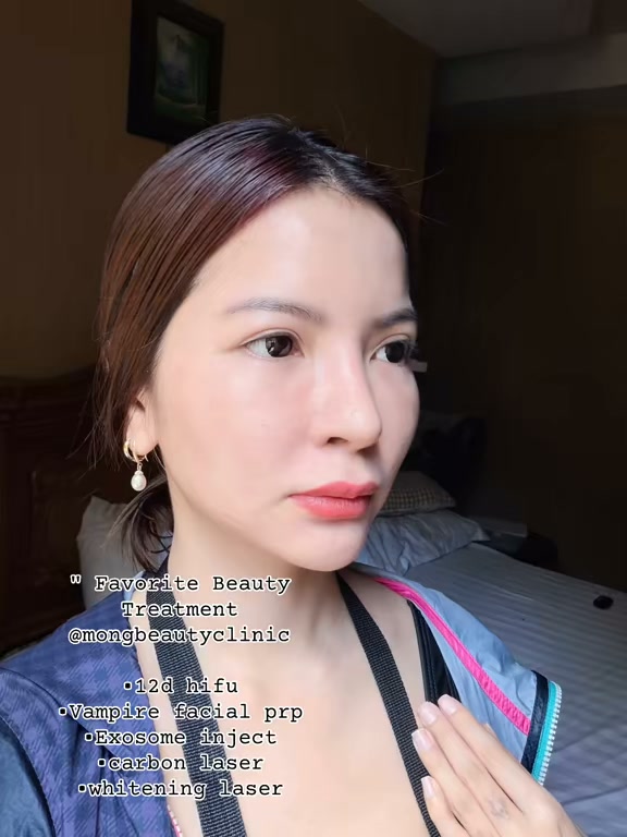 ✨ My Favorite Beauty Treatments at Mong Beauty Clinic ✨, Sharing some of my personal favorites for that fresh, glowing, and rejuvenated look 🤍, ✨ 12D HIFU, ✨ Carbon Laser, ✨ Whitening Laser, ✨ Vampire 