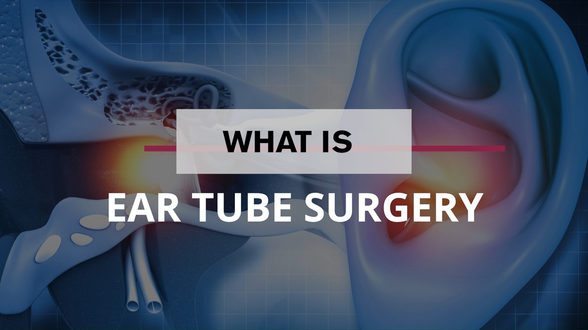 Did you know that the placement of ear tubes is the most common surgery ...