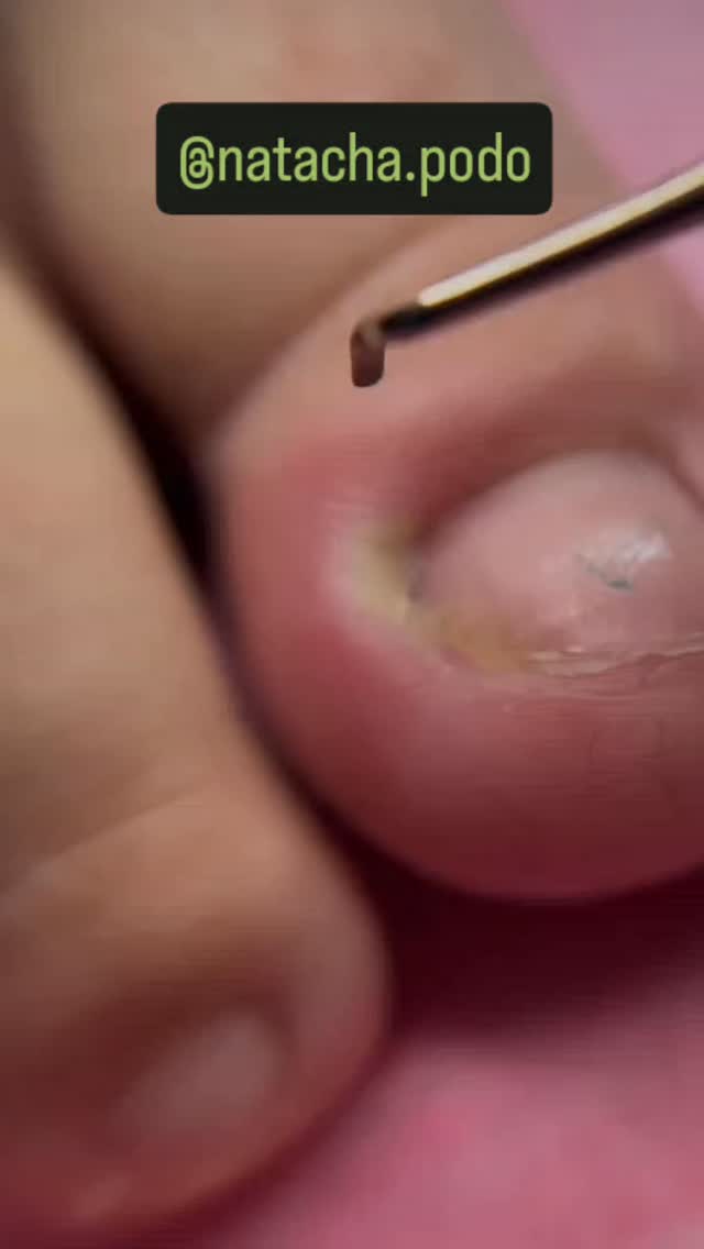 Drenagem🤗 Sim, infecções principalmente bacterianas geram pus como ...