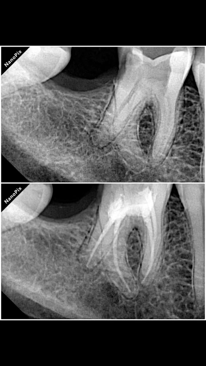 A case of RADIX ENTOMOLARIS 