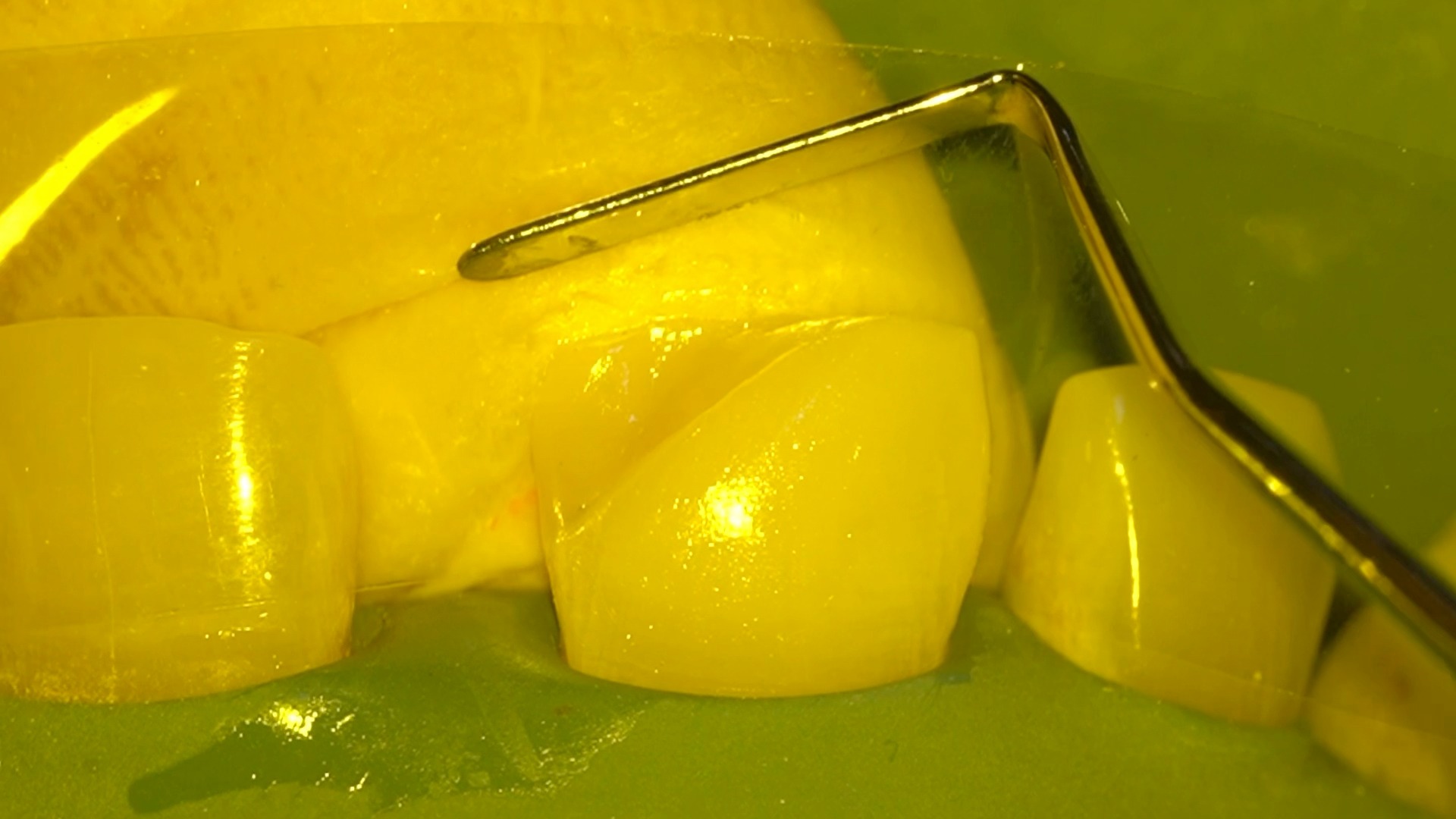 Free hand palatal shell building اهم حاجه في التكنيك دا هي ال position ...