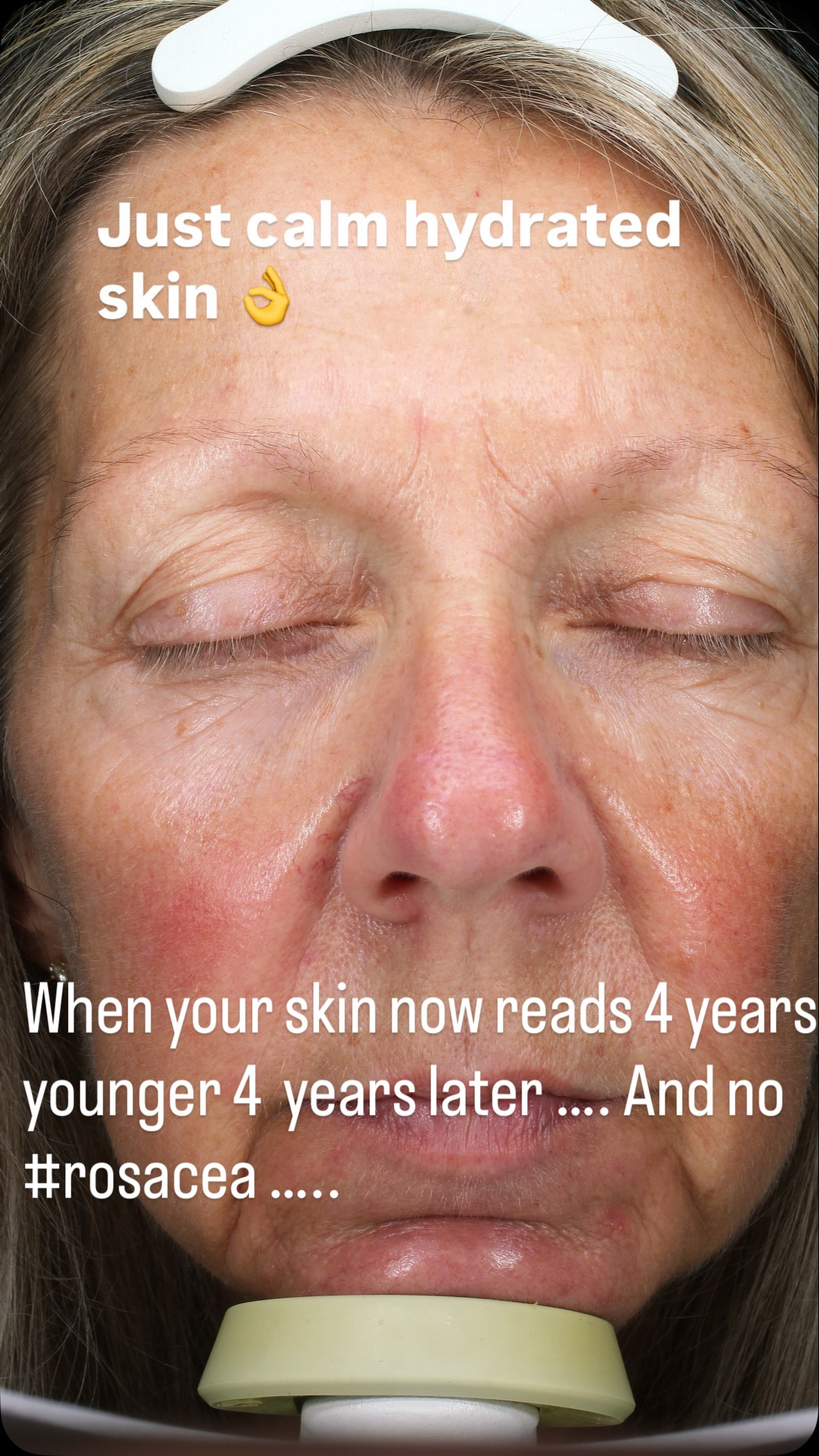 melanotan used for rosacea After working on 10 years carefully documenting all of our cases and considering the treatments that actually work … and those that don’t … we realised the following : , 🤩antibiotics are tag__hot_Made For Women
