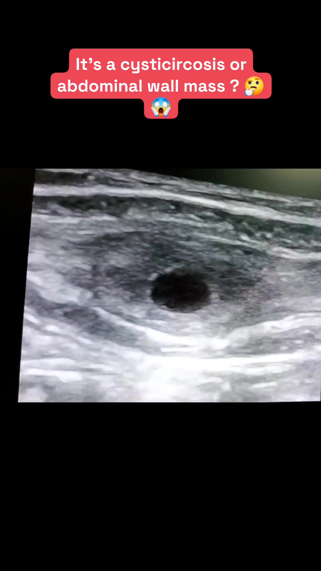 A middle age pt. Hx feel a lump and mild pain at unilateral ...