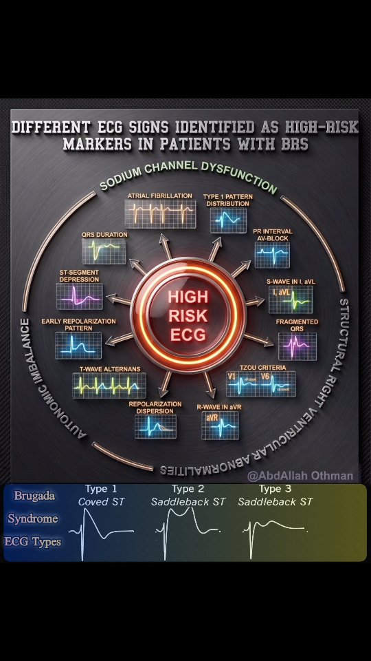 🎯📉High-Risk ECG Markers in Brugada Syndrome (BrS) This visual guide ...