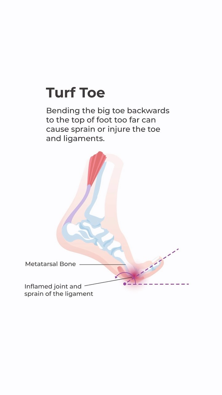 Turf toe. Genuinely one of the worst-named injuries in sports, and one of the most underestimated., It’s an injury to the ligaments of the big toe joint, almost always from hyperextension. The kind of 