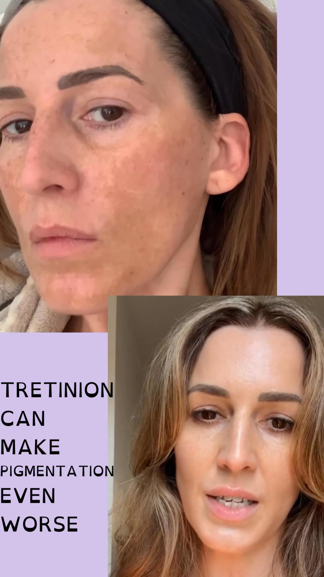 Pigmentation doesn't take seasons off. Neither should your skin routine. “ Dermagen gives me a daily glow all year round. It has helped with my pigmentation, and I absolutely love it.” Dermagen Skin
