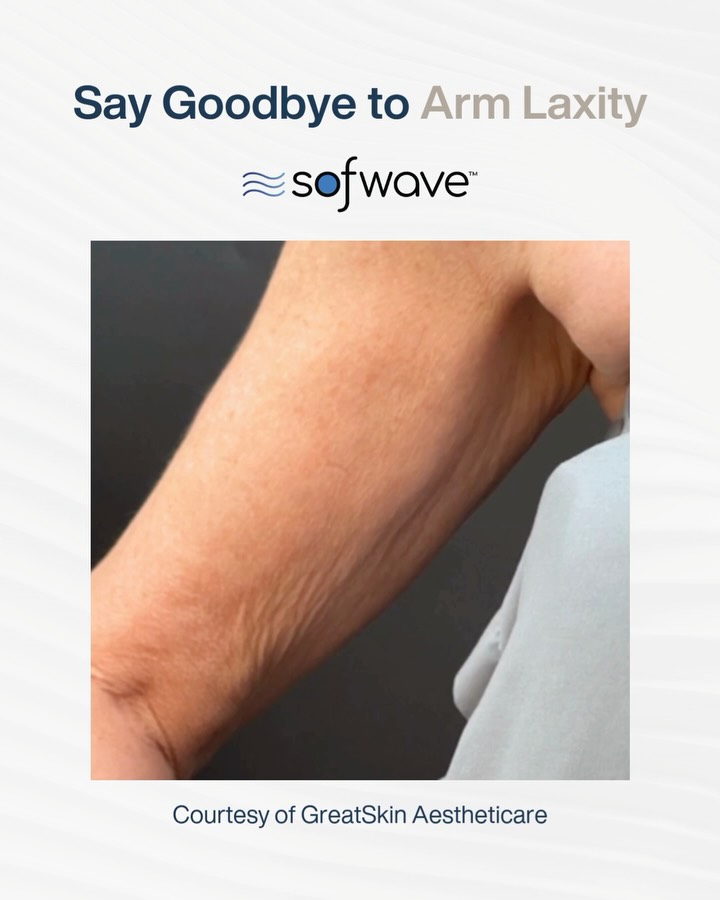 Arms are one of the most common areas to show skin laxity