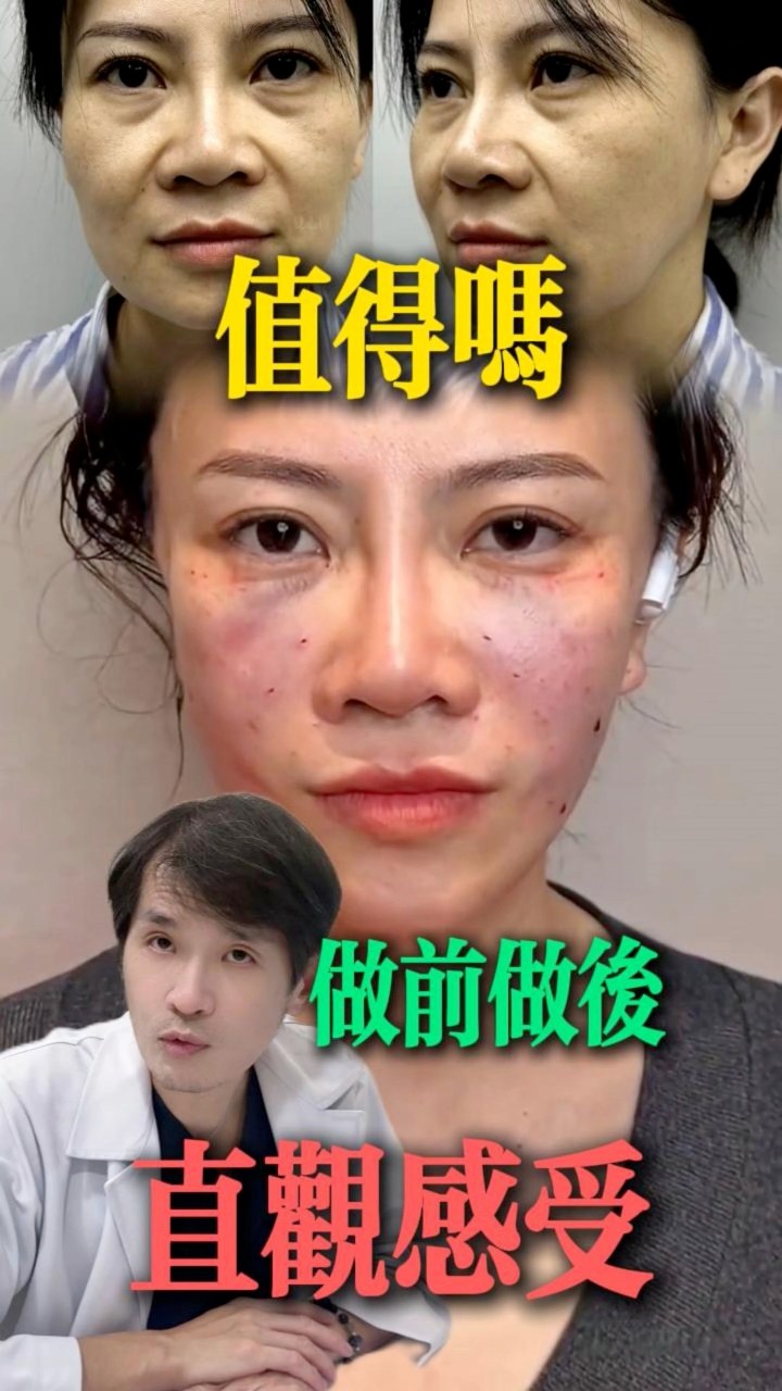 #台灣 #面部提升 #微整 #抗衰 #眼綜合 #去眼袋 #抗衰 #醫美 #整形 #年輕化#台灣 #台北 #面部提拉 | Xie Yu ...