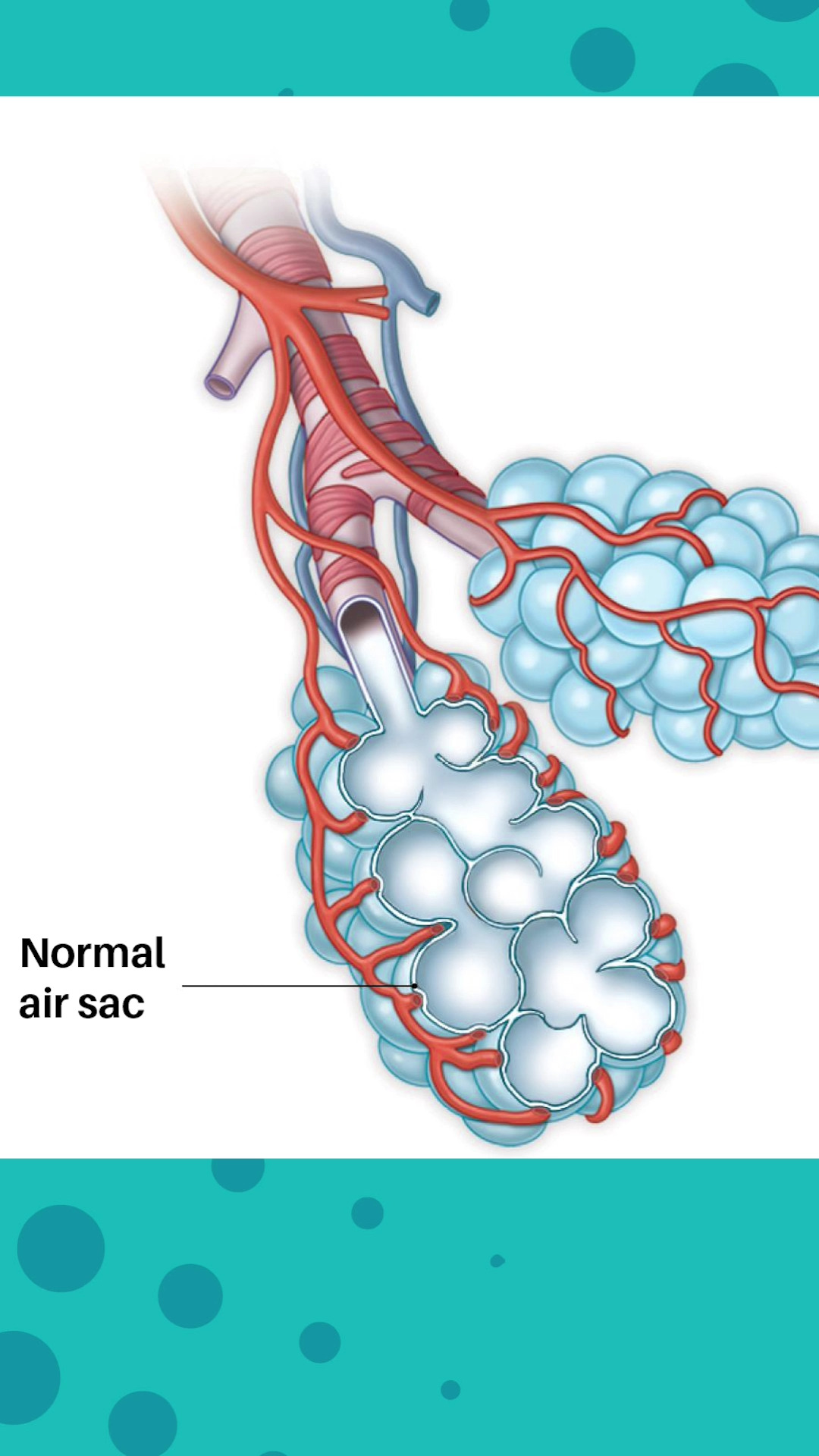 Your lung is made up of millions of tiny air sacs called “alveoli.” The ...