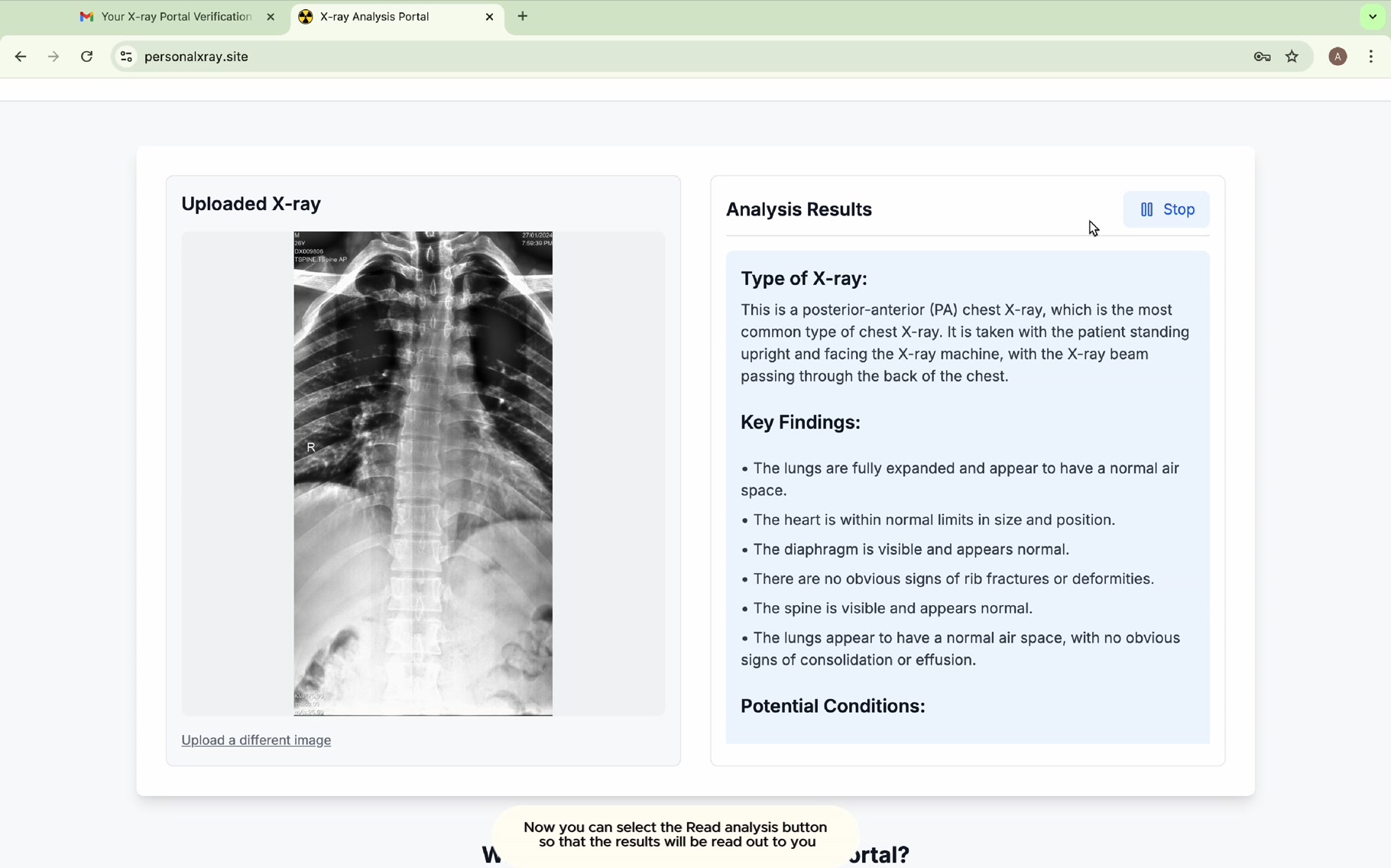 🎥 X-ray Analysis Portal Demo: AI-Powered Medical Analysis in Seconds ...