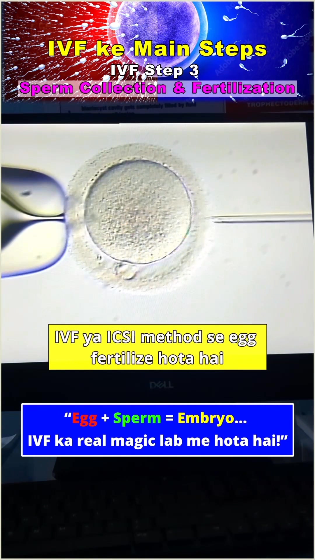 IVF Step 3 – Sperm Collection & Fertilization | Day 8 | IVF Treatment # ...