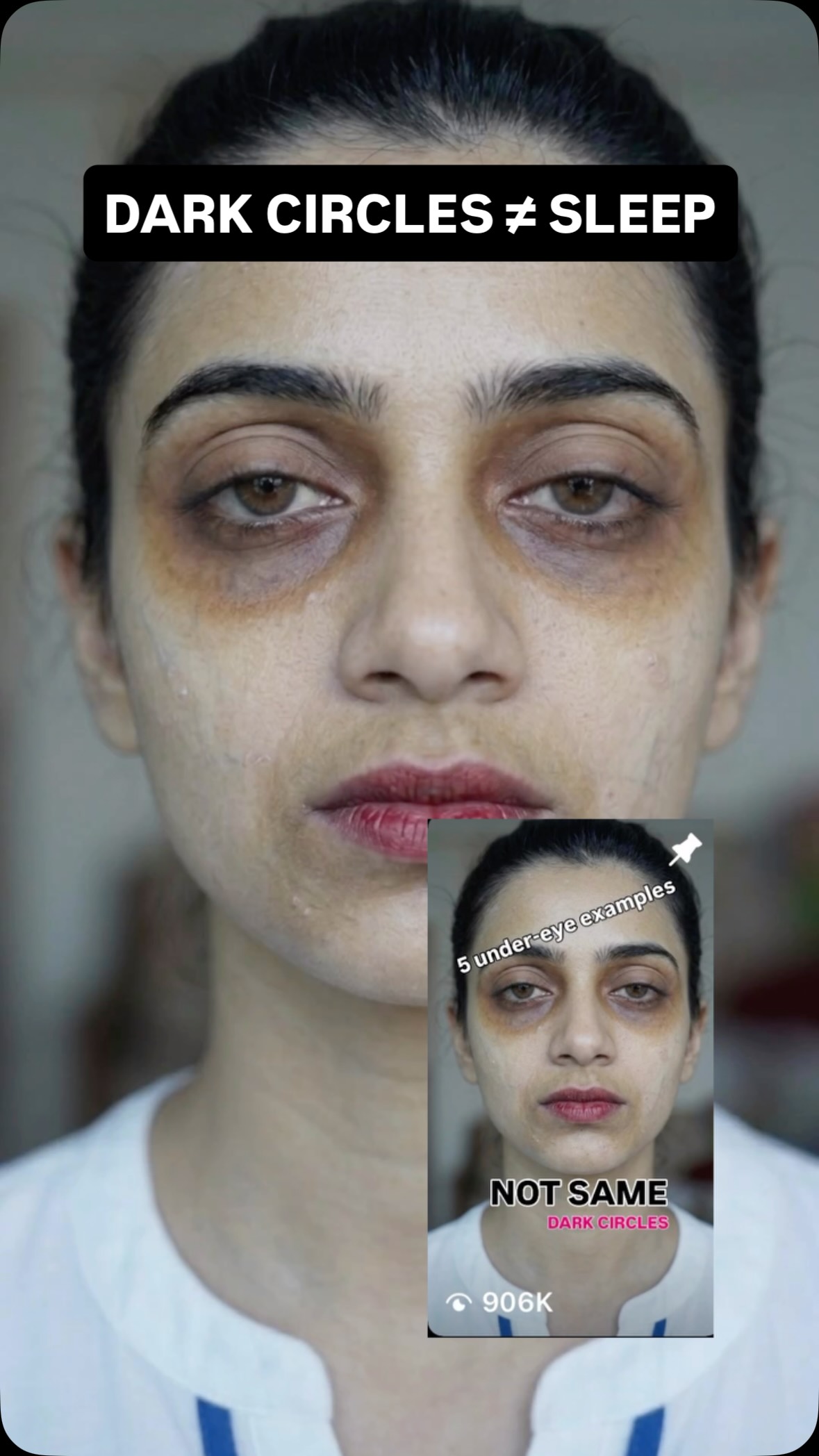 b12 injection hereditary dark circles under your eyes—sound familiar? 😴 From lack of sleep to genetics, there are several culprits behind those pesky shadows. In our one-minute DocShorts video, our Consultant Dermatologist Dr Shweta Manchanda nad+
