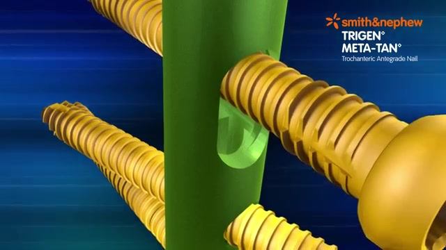 TRIGEN META-TAN Stability and Versatility for high proximal fractures ...
