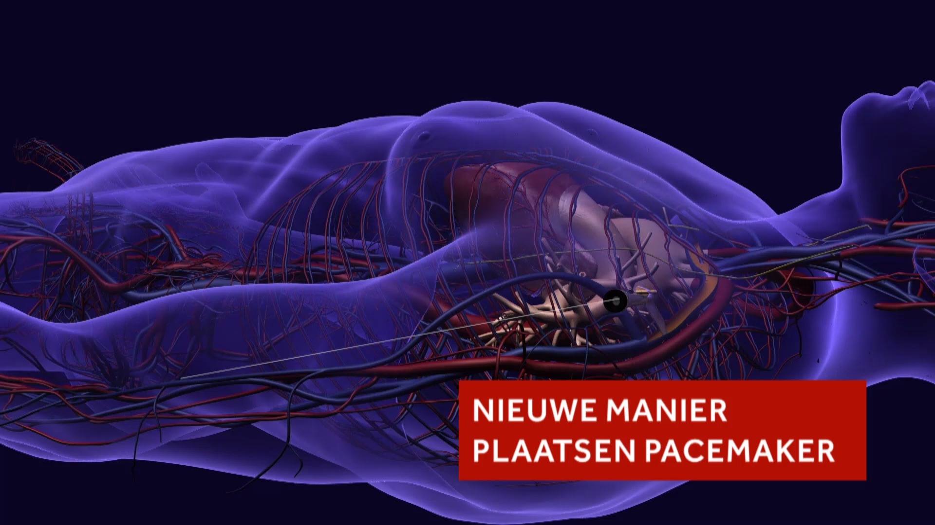 Nieuwe manier om pacemaker te plaatsen | Artsen van het UMC Utrecht ...