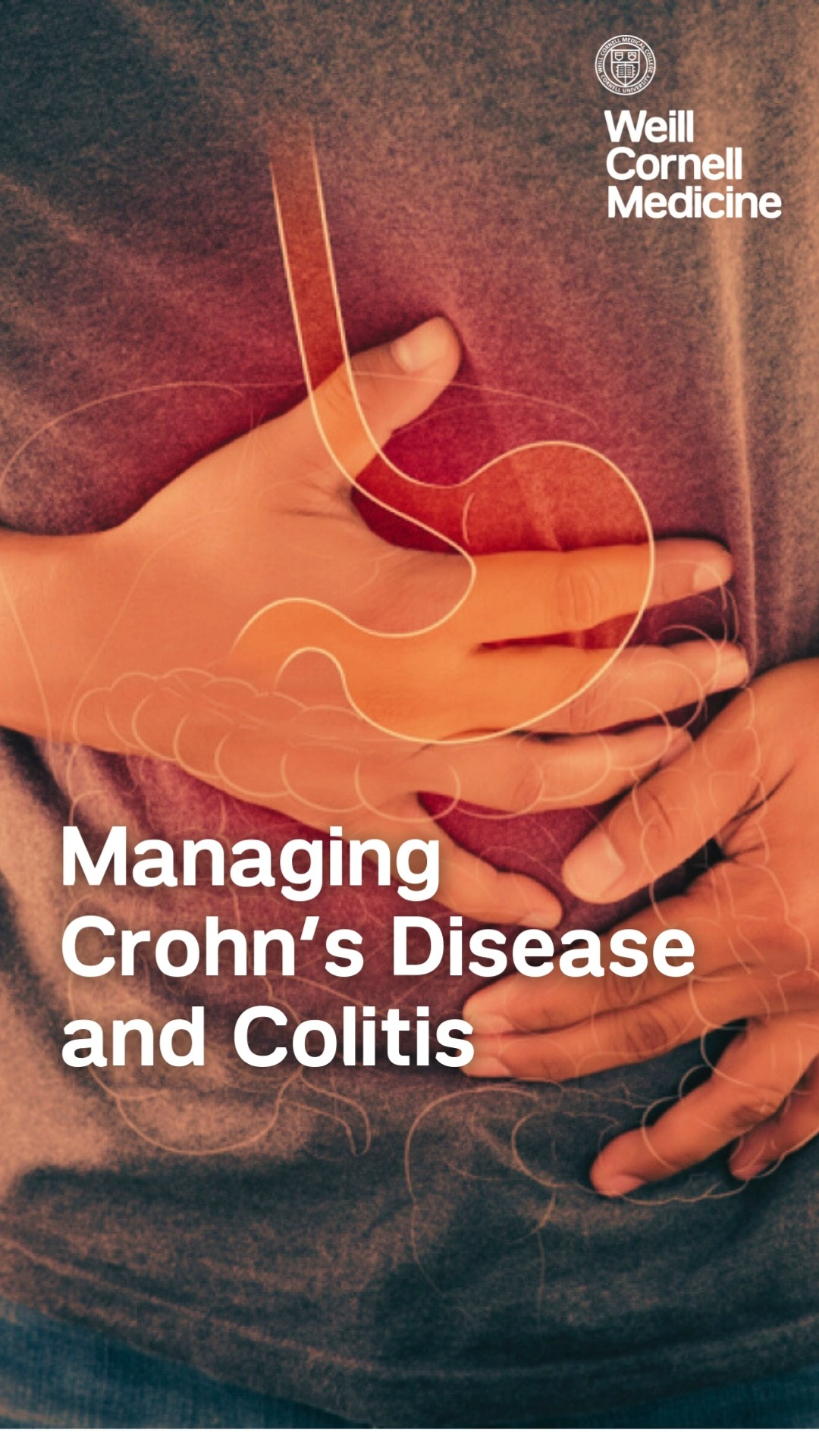 bpc 157 and crohn's disease Living with or colitis can be challenging, but knowing more about these conditions is the first step to managing them. These chronic inflammatory bowel diseases (IBD) affect the Neurobion Forte Vitamin B12 Quantity:30 capsules Type_Multi dose vials