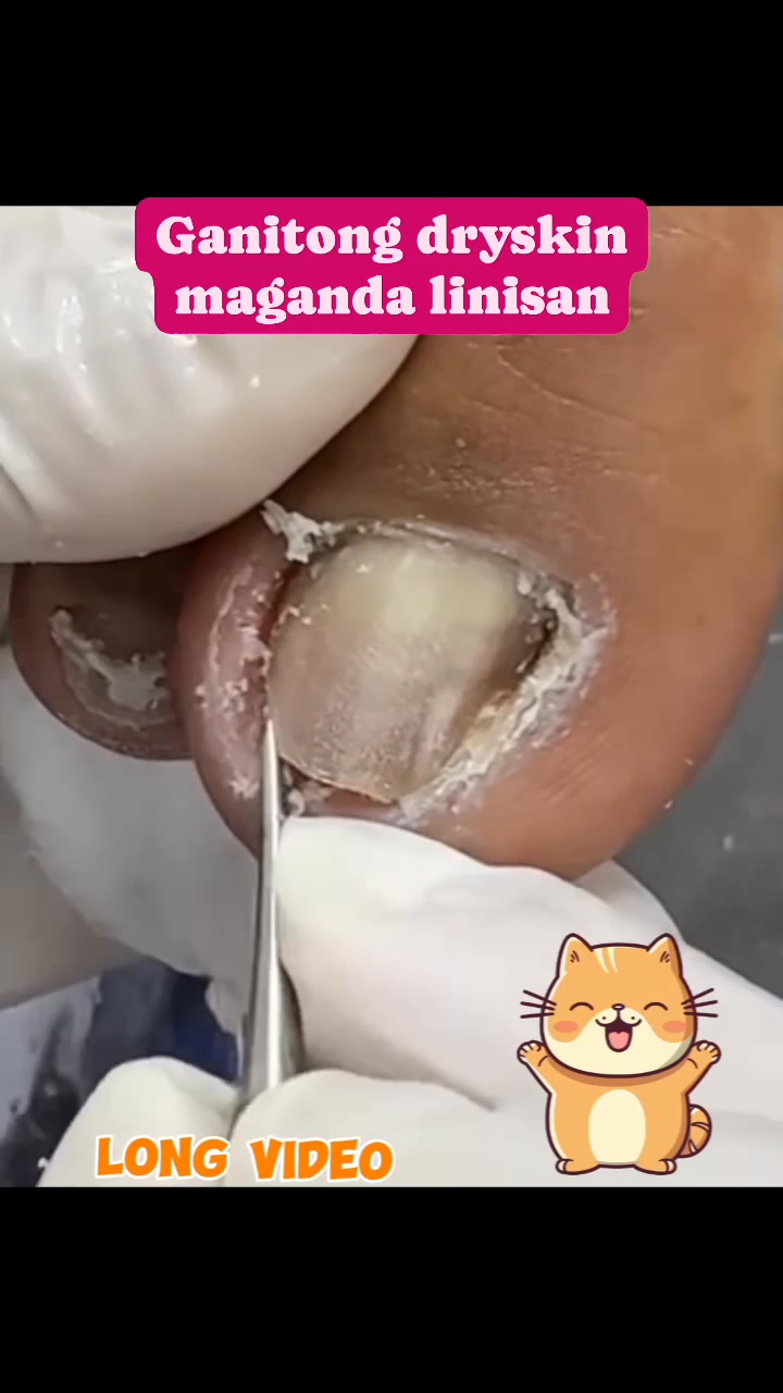 Ganitong dryskin maganda linisan. #ingrowncleaning #cleaningingrown # ...