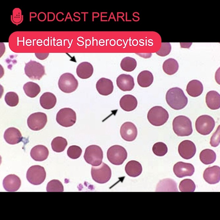 Hereditary spherocytosis is an autosomal dominant disease that results ...