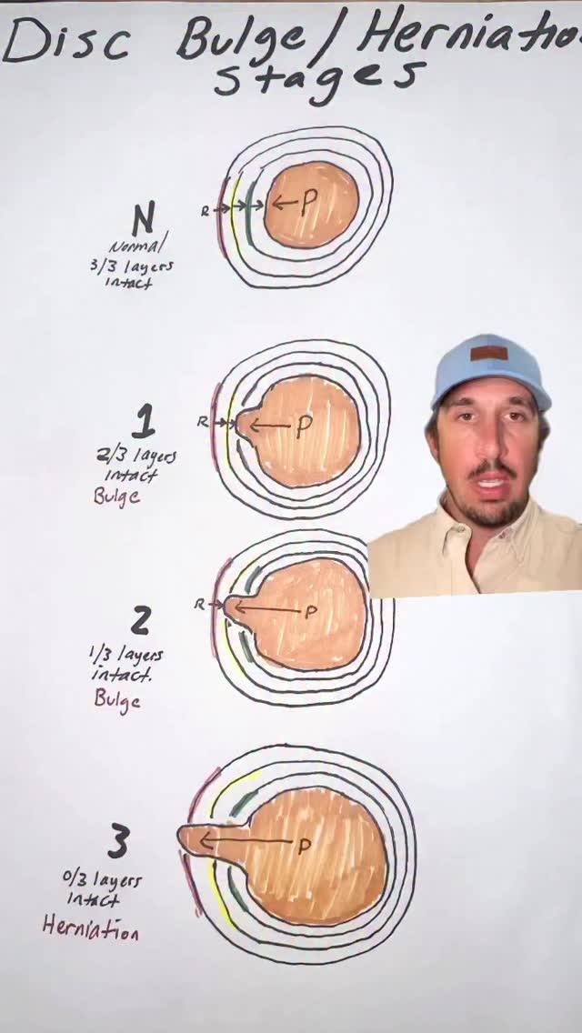 Did you know a disc bulge happens when the inner nucleus of your spinal ...