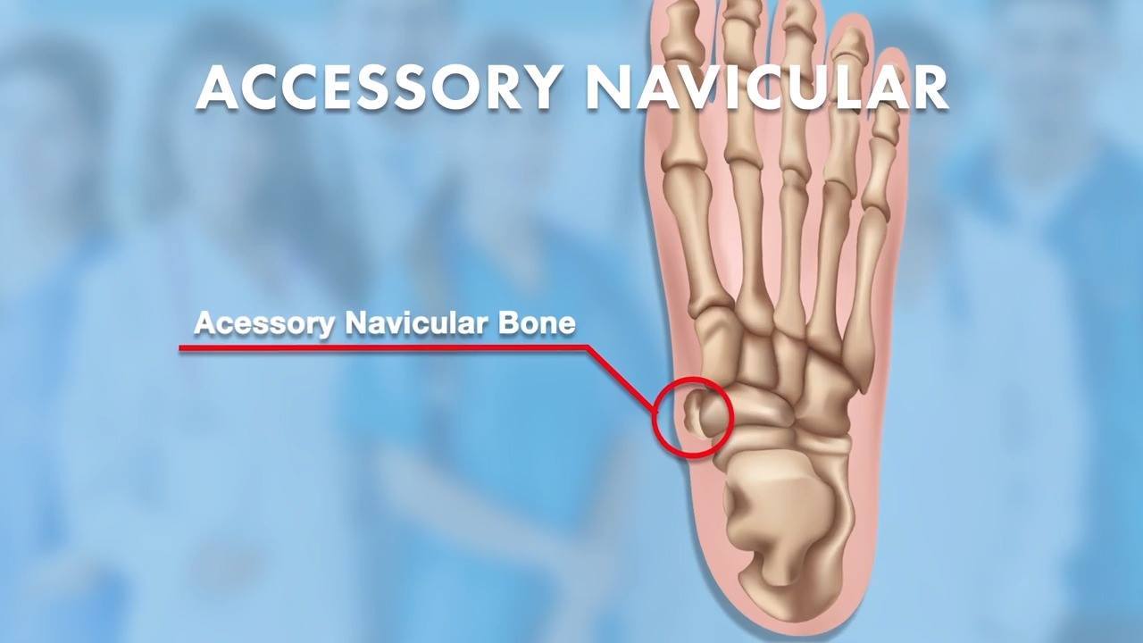 Ask Dr. Silverman - What is Accessory Navicular? | An 