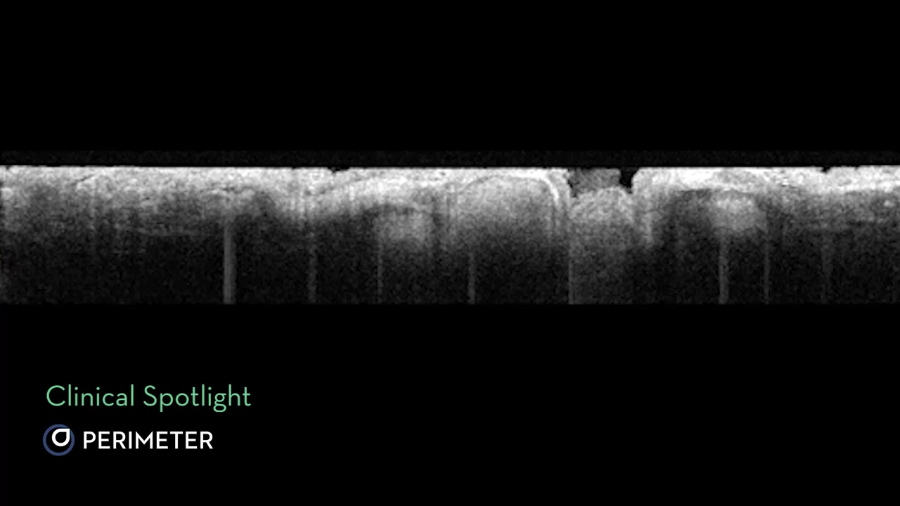 Clinical Spotlight —> This margin was obtained from a lumpectomy ...