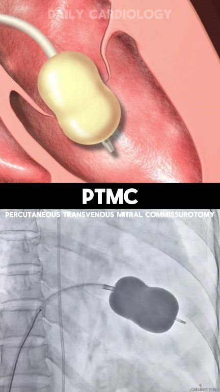 PTMC (Percutaneous Transvenous Mitral Commissurotomy) | Daily ...