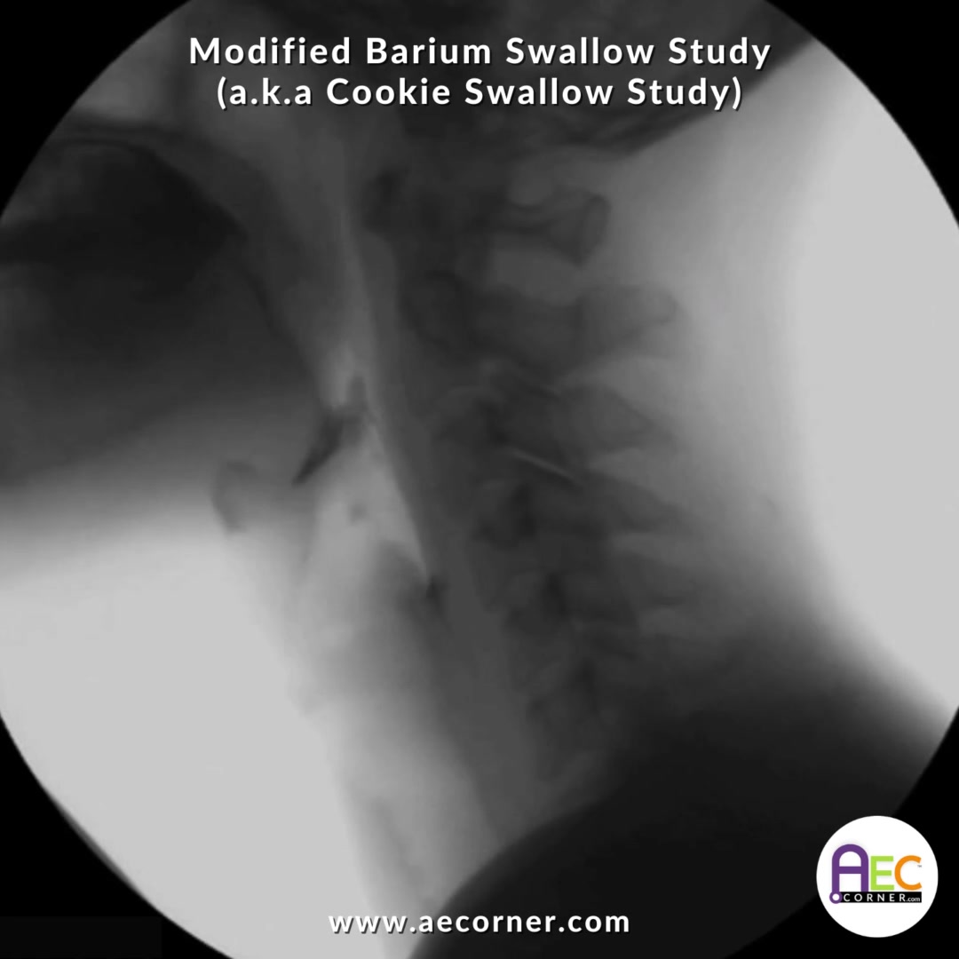 Modified Barium Swallow MBSS/VFSS Patient Education Handout