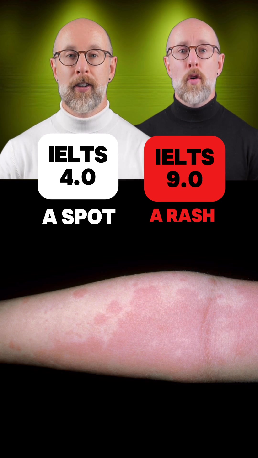 Do you know these skin words? a stye: A sore bump on the eyelid. a ...