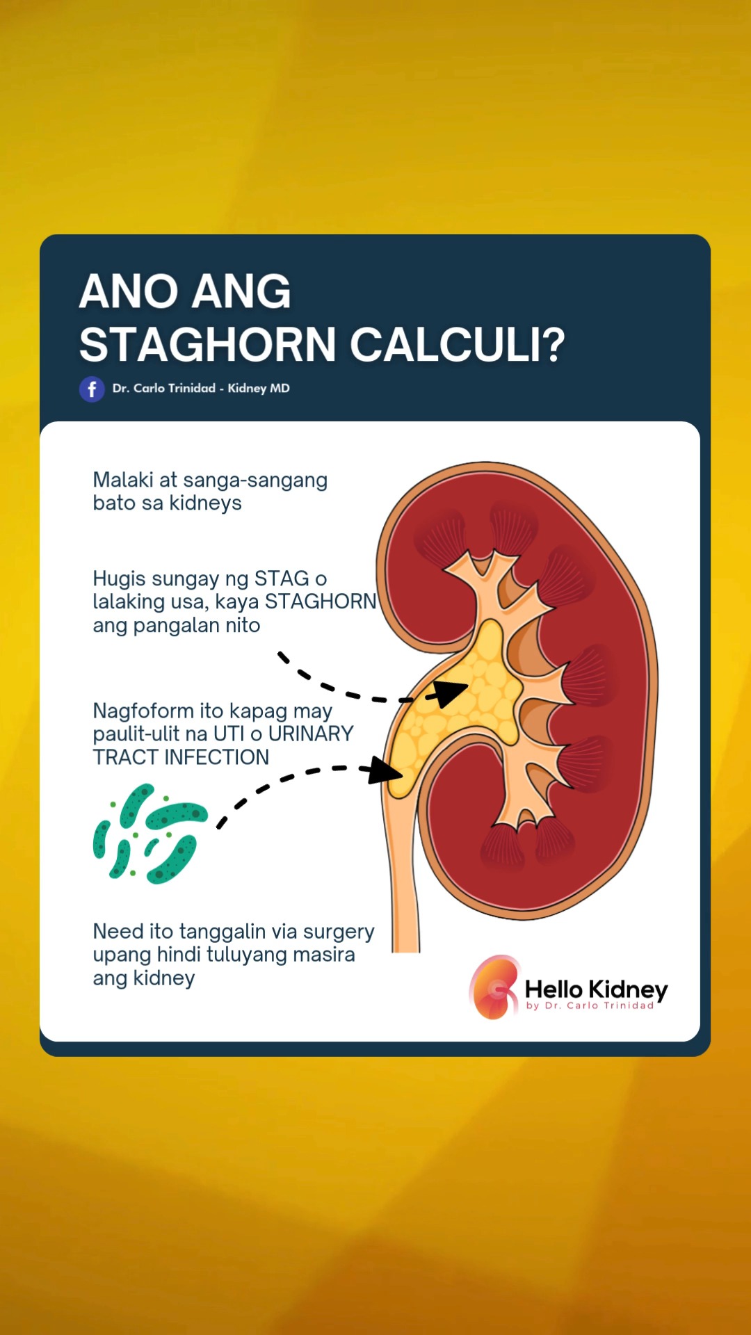 Ano ang staghorn calculi? #kidneystones #kidneydisease | Dr. Carlo ...