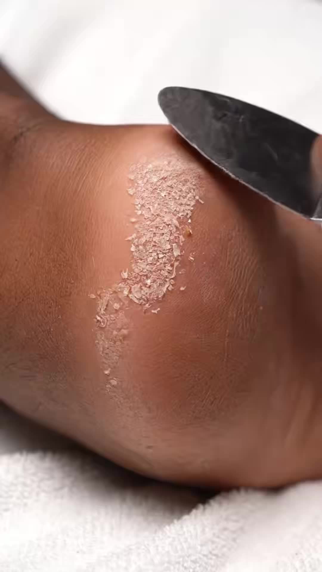 Foot Care Texture Treat | ASMR Exfoliation VH3S #footcare # ...