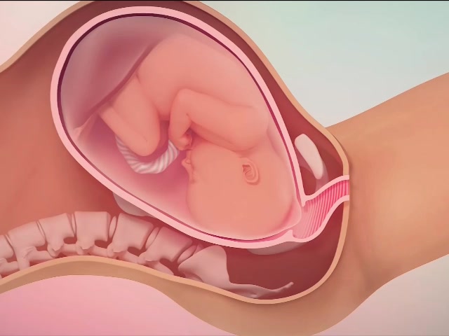 An amniotomy, also called an artificial rupture of membranes (AROM) or ...
