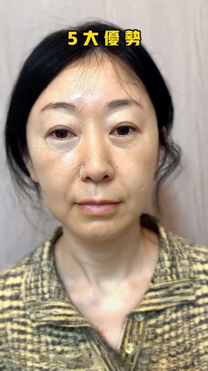 #台灣 #微整#醫美#輪廓提升#抗衰#顏值#美女 #法令紋#淚溝#黑眼圈#去眼袋#筋膜提升#提眉 | Xie Yu | Facebook