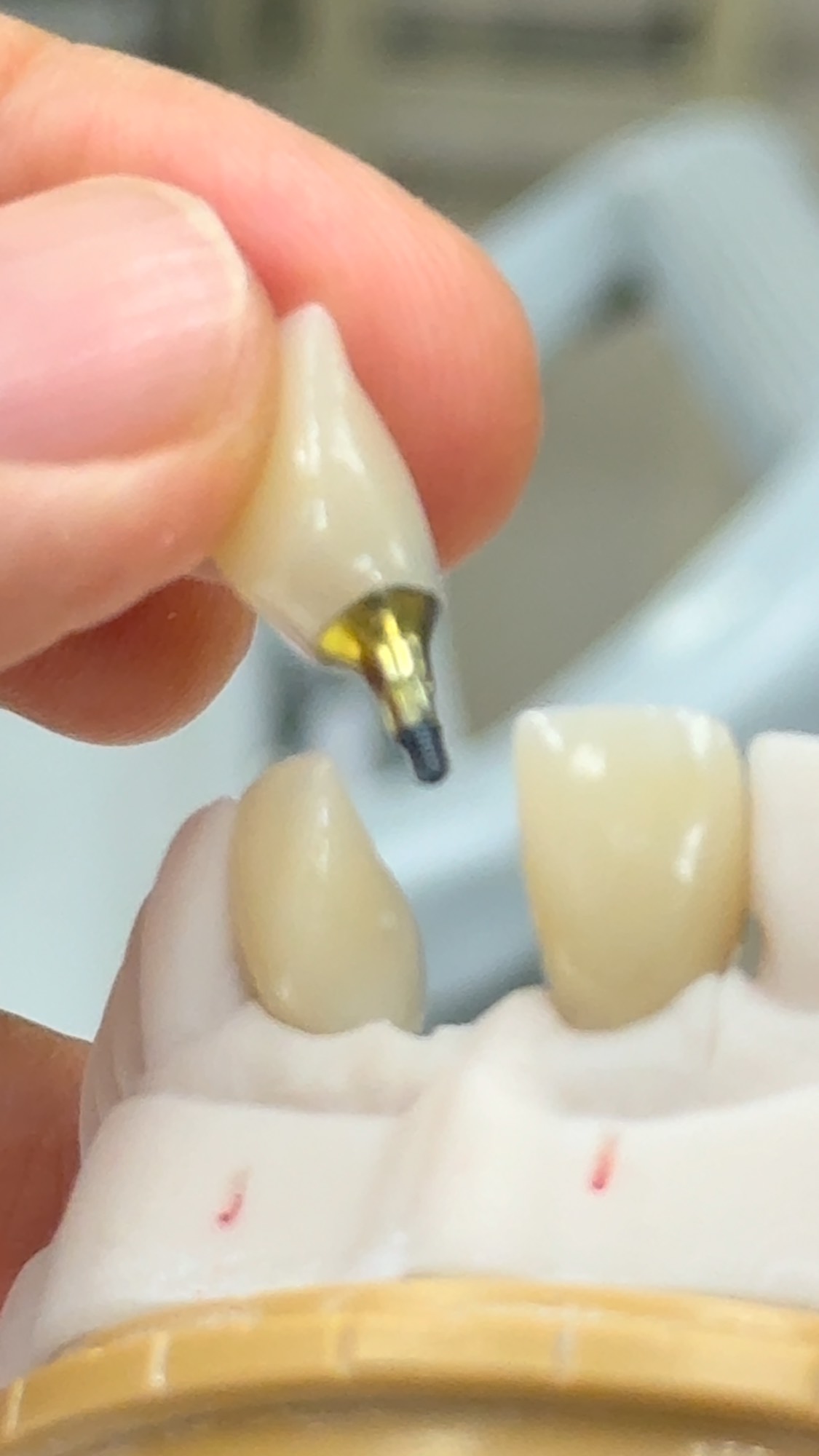 The custom mini syton hybrid implants with ceramics! From Dr.Jonathan ...