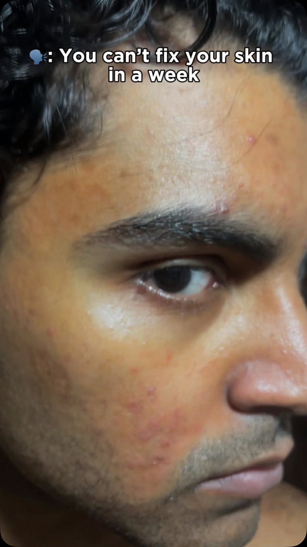 comment “glow” for link! , #acne #tan #skincare #glutathione | Pilgrim
