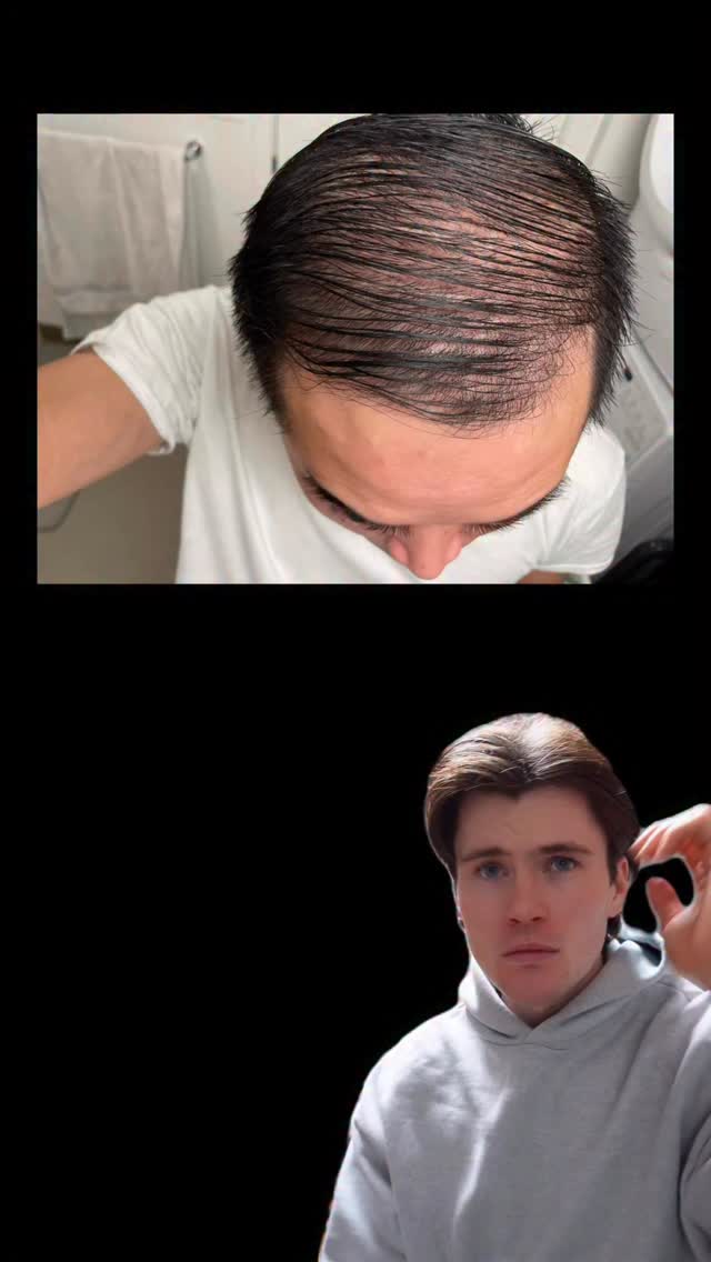 His protocol! ⬇️, Shoutout Reddit user u/yukinami04 for sharing his hair loss results! 👏🏻 , He used:, - Oral finasteride 1mg daily.,