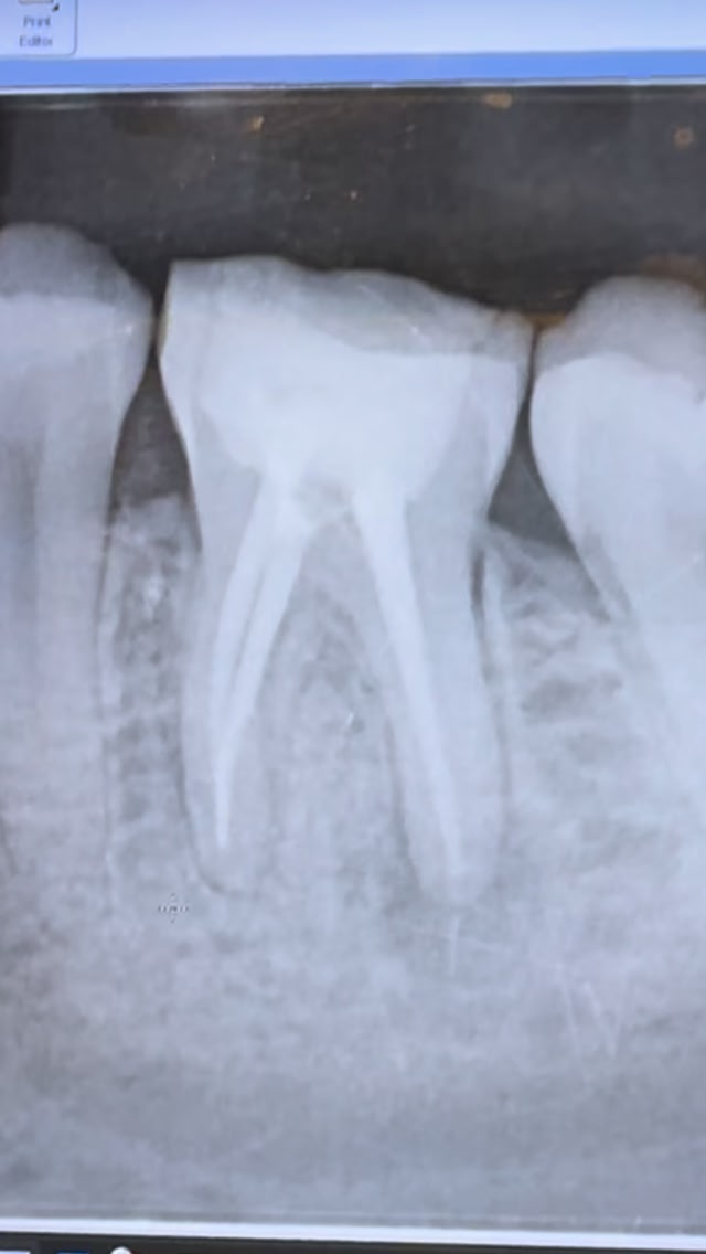 When an old root canal becomes infected, it doesn’t mean the tooth is ...